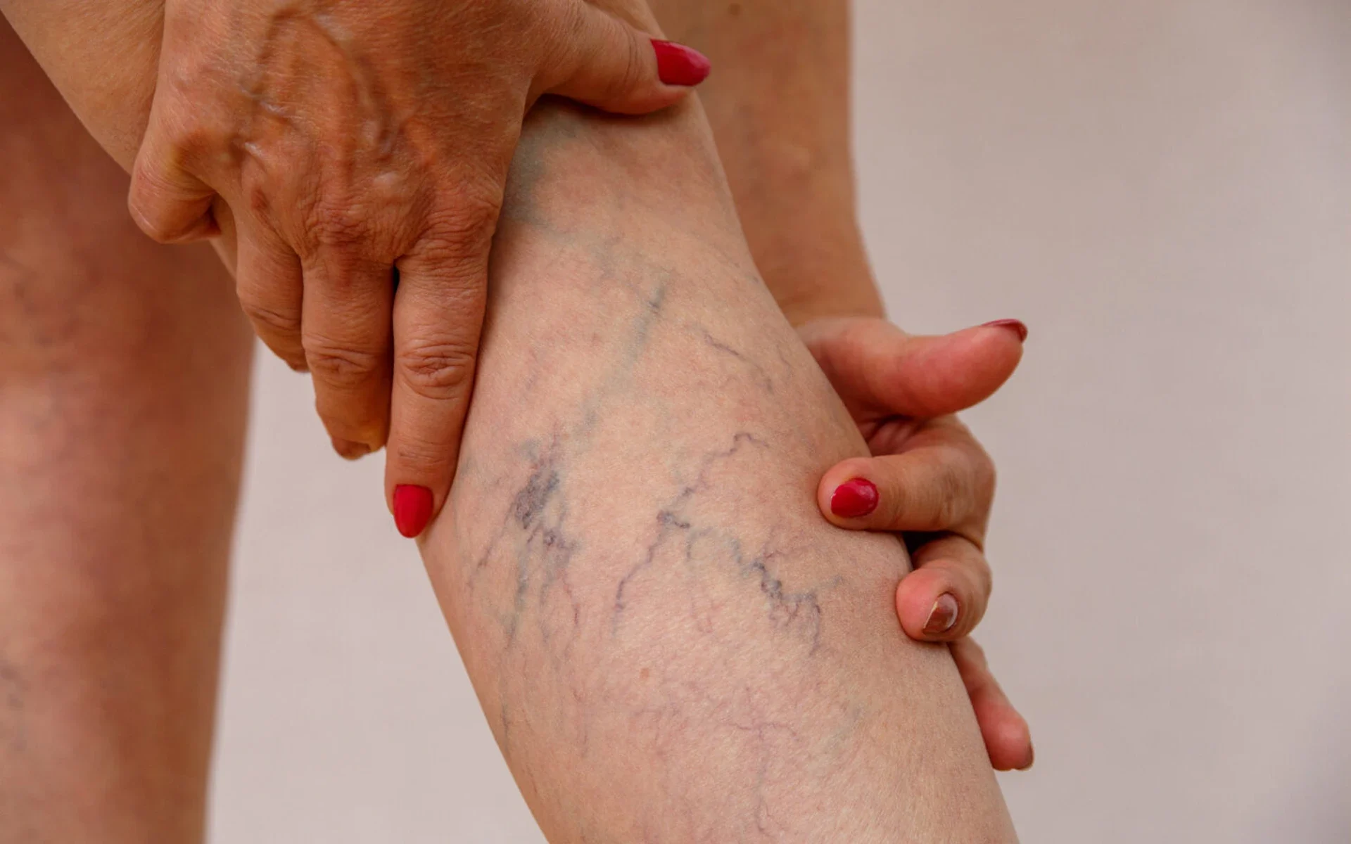 Person examines leg with visible varicose veins.