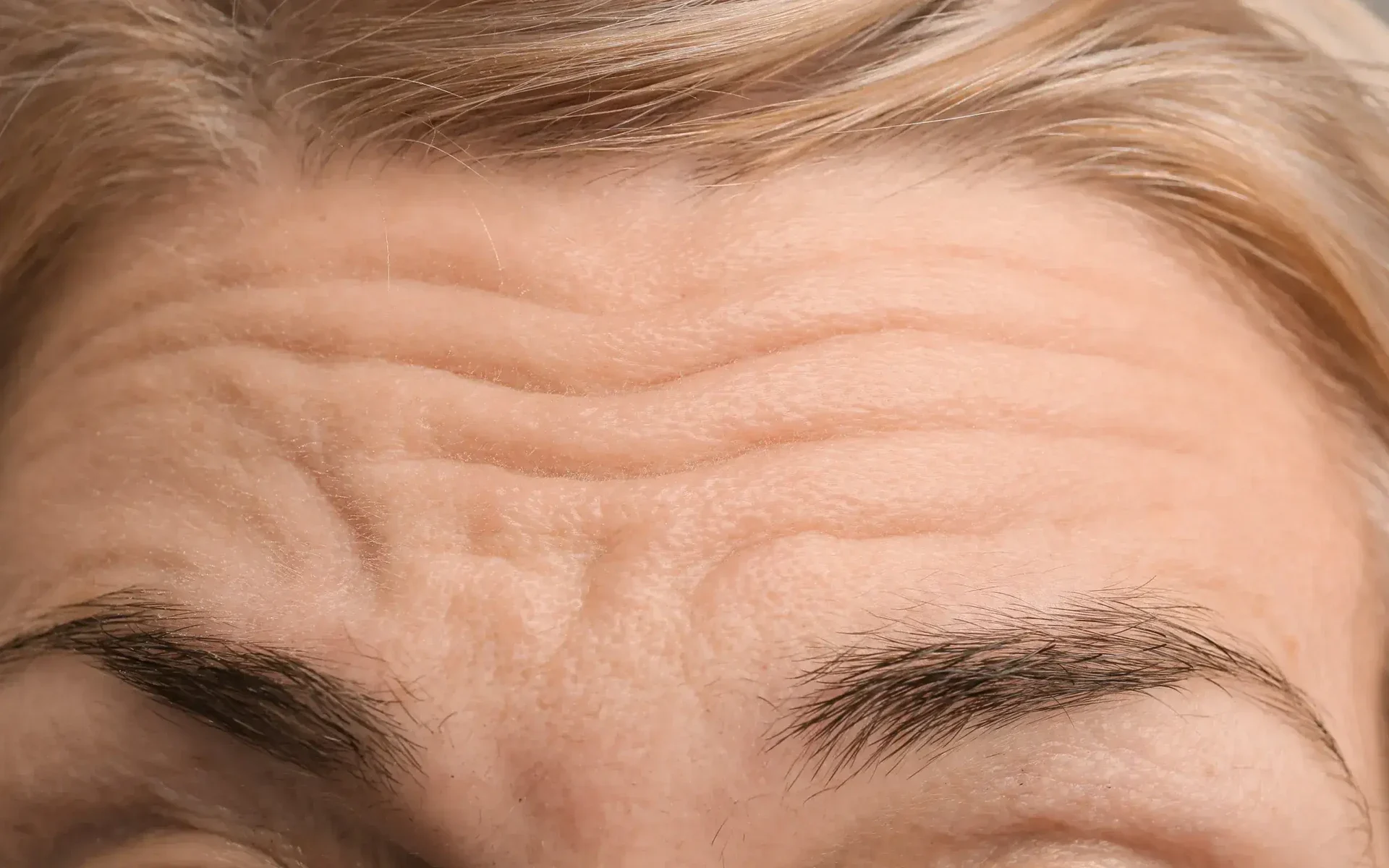 Close-up of forehead wrinkles and eyebrows.
